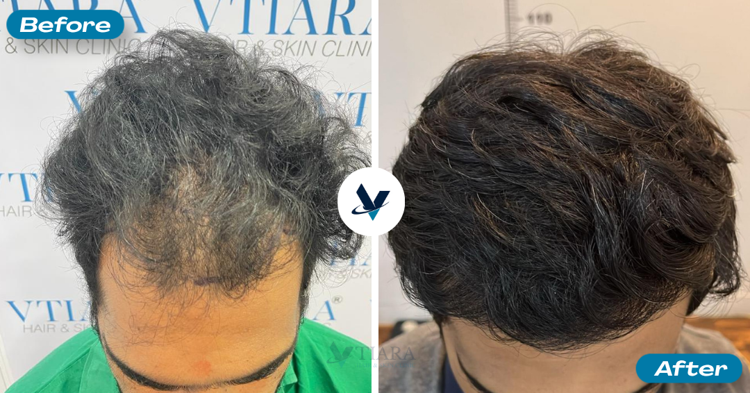 Hair Transplant Result 10 - Before and After