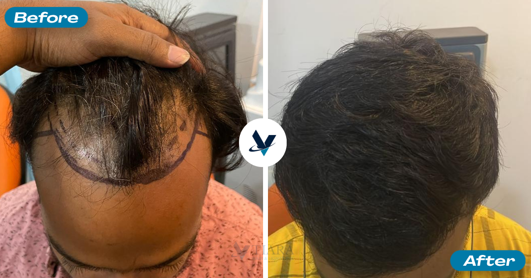 Hair Transplant Result 8 - Before and After
